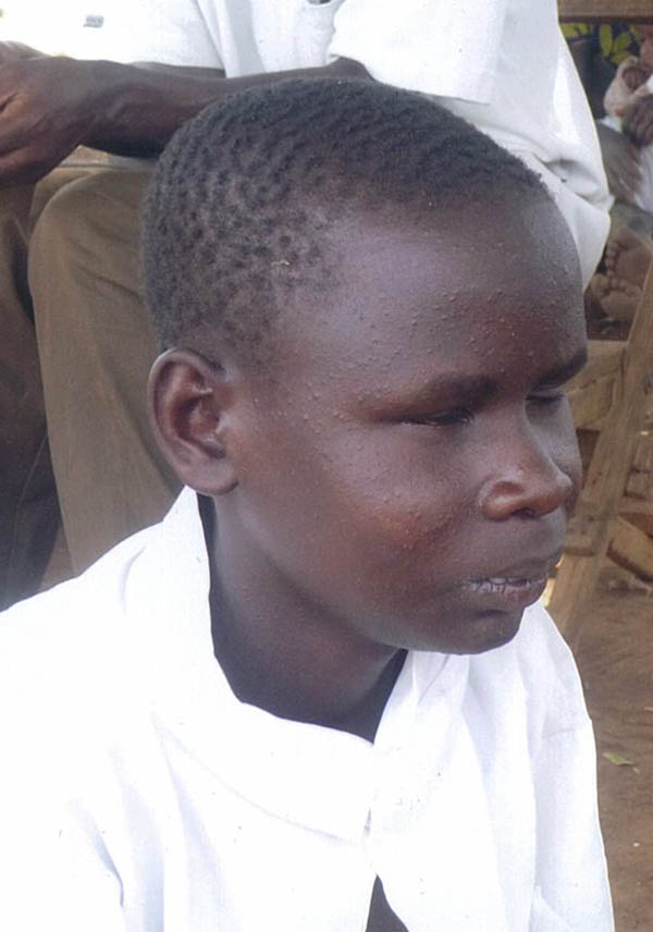 Inner Wheel Sponsor Blind African Boy